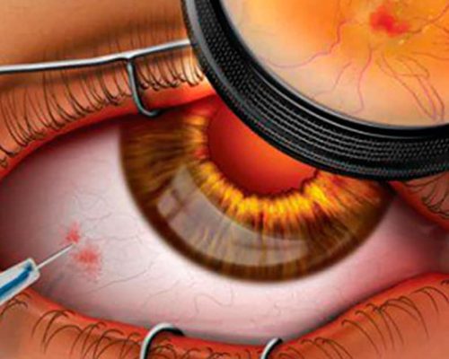injeção-doenças-retinianas