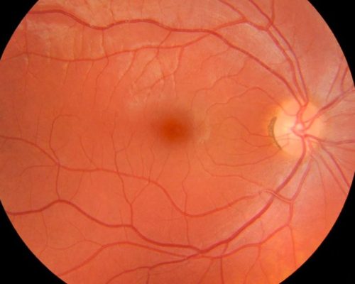 nervo_optico_oftalmologia_g